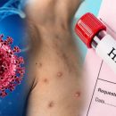 Man tests positive for HIV, COVID-19, and monkeypox at the same time