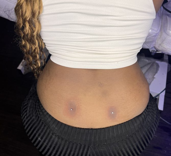 Lady lands in the hospital after getting a back dimple piercing